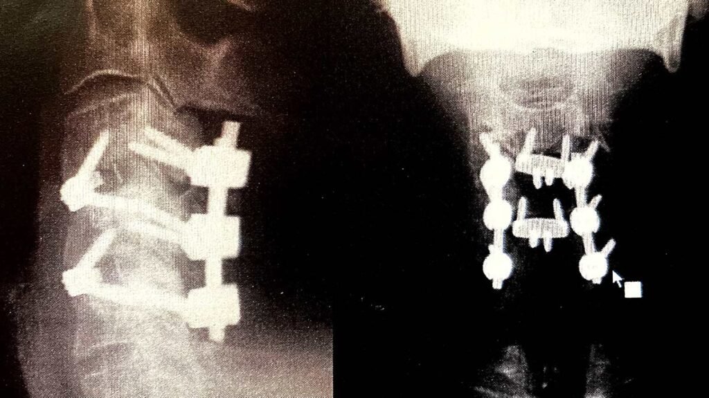 X-Ray of Vance Duggers broken vertebrae